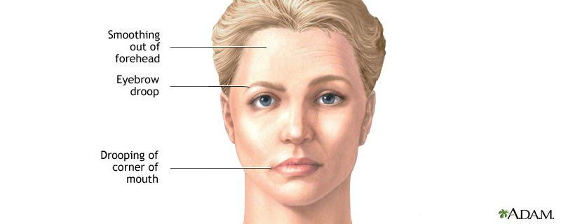 Zenith reccomend Facial muscle paralysis
