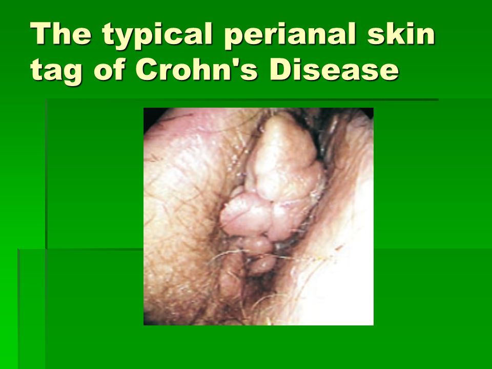 Uncle recommend best of anal crohns Pics tags of