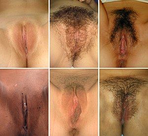 best of Ulcers vagina Apthous and