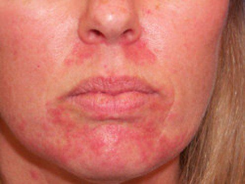 best of Remedies Facial rash