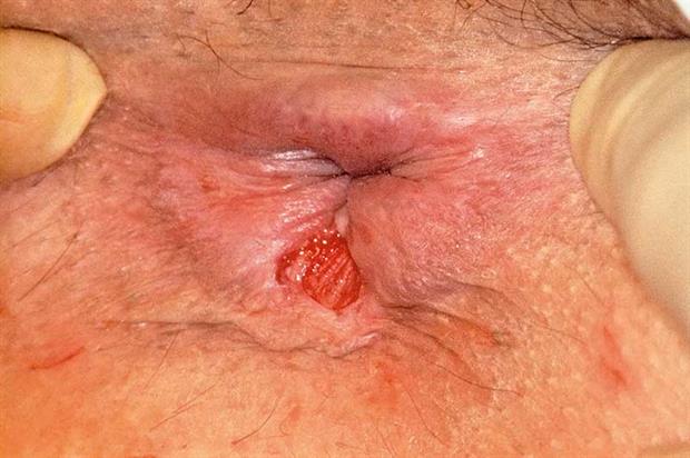 best of Bleeding and Anal swelling