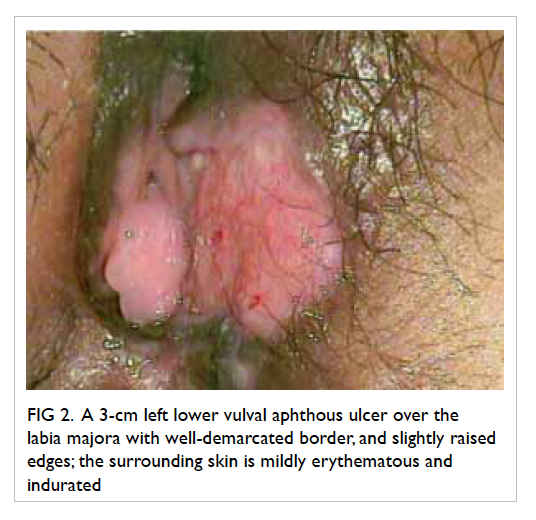 Shooting S. reccomend Apthous ulcers and vagina