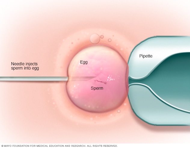 best of Sperm Sex determination harsh vagina environment