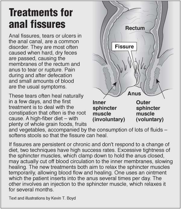 best of Fissures for anal Immediate relief