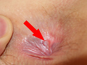 Anal swelling and bleeding