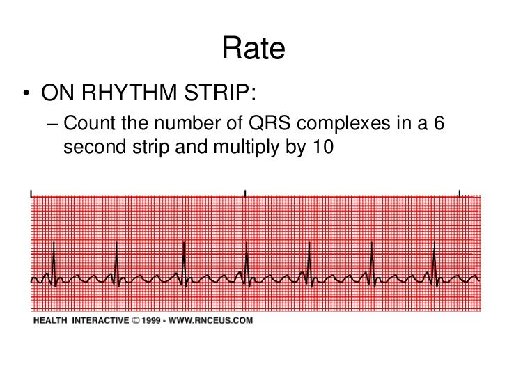 Big L. reccomend Cardiac arrest ekg strip