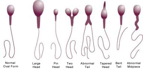 Fertility abnormal sperm