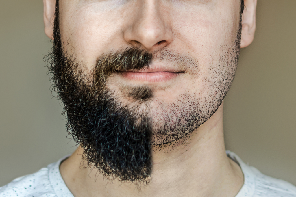 best of And Facial testosterone hair