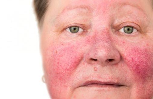 Facial rash remedies