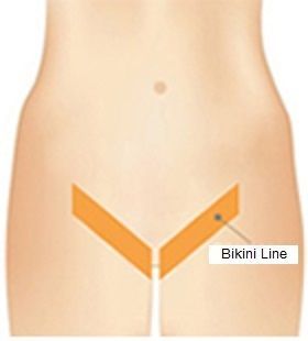 Banshee reccomend Bikini line lazor