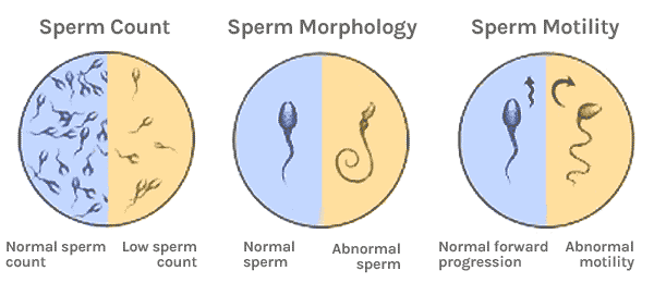 best of Sperm Fertility abnormal