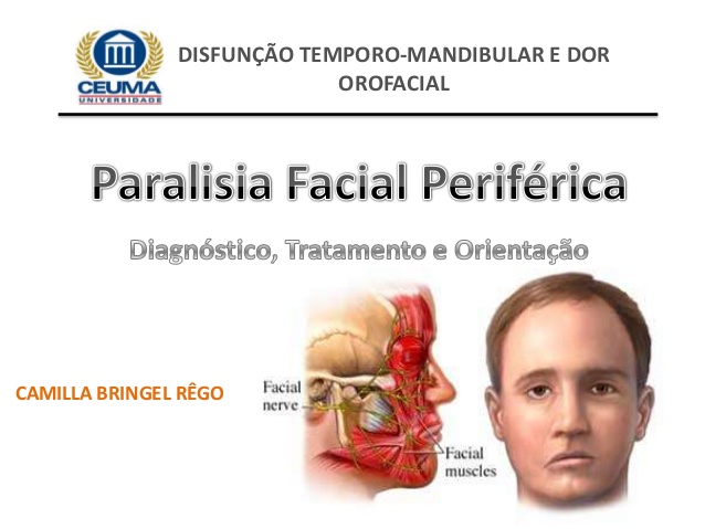 Aquamarine reccomend Paralisia facial periferica